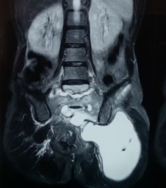 Sacral TB with abscess