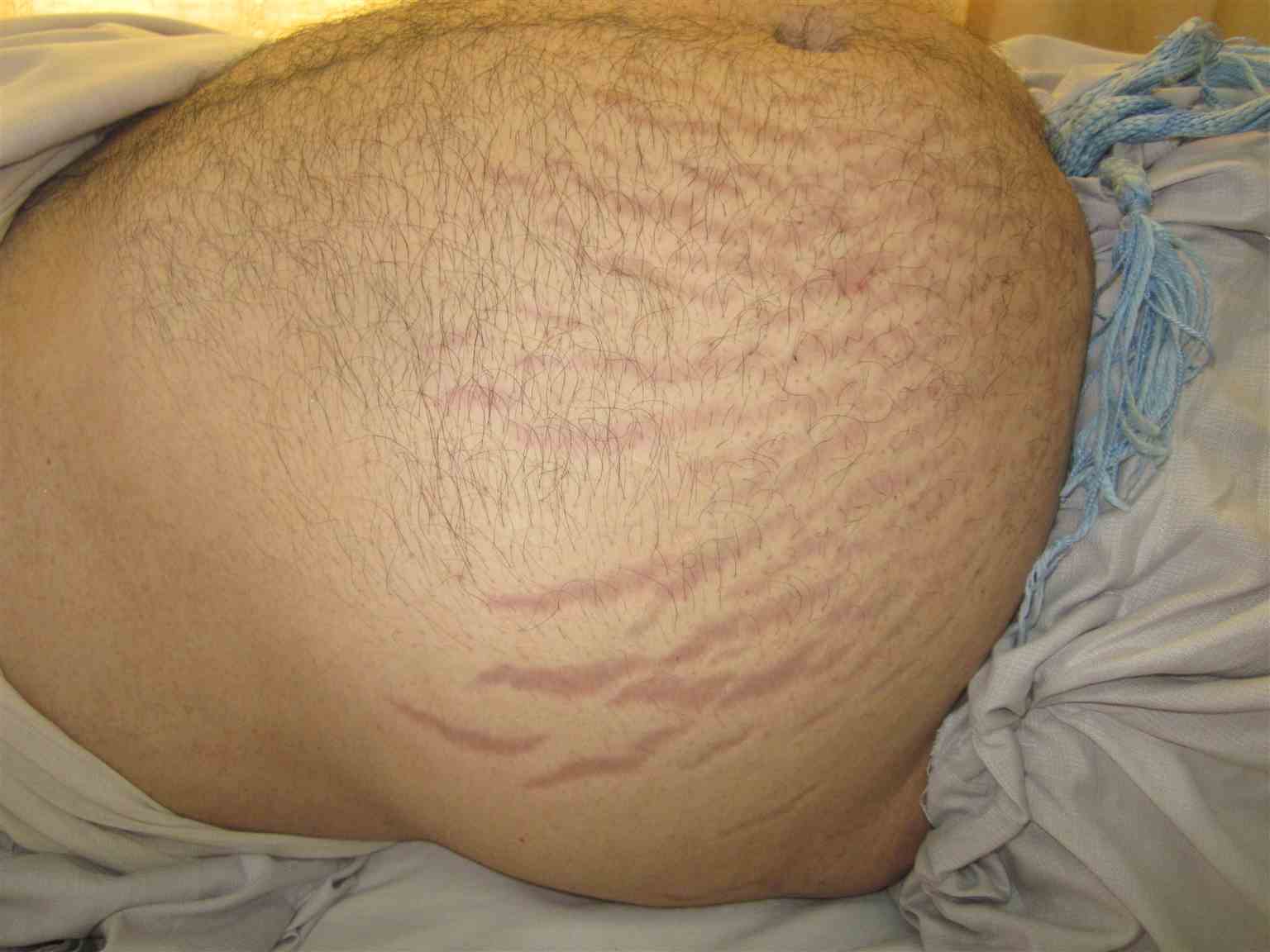 <p>Cushing Syndrome. Vertical purplish abdominal striae is seen in a patient with Cushing syndrome.</p>