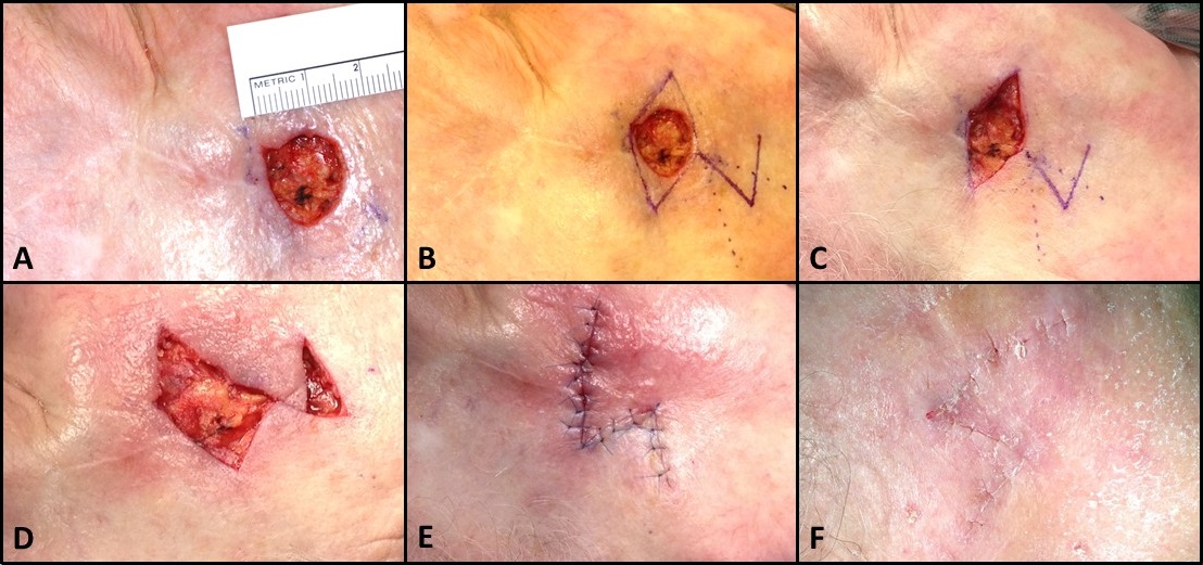 <p>Rhombic Flap for Mohs Defect of the Right Cheek