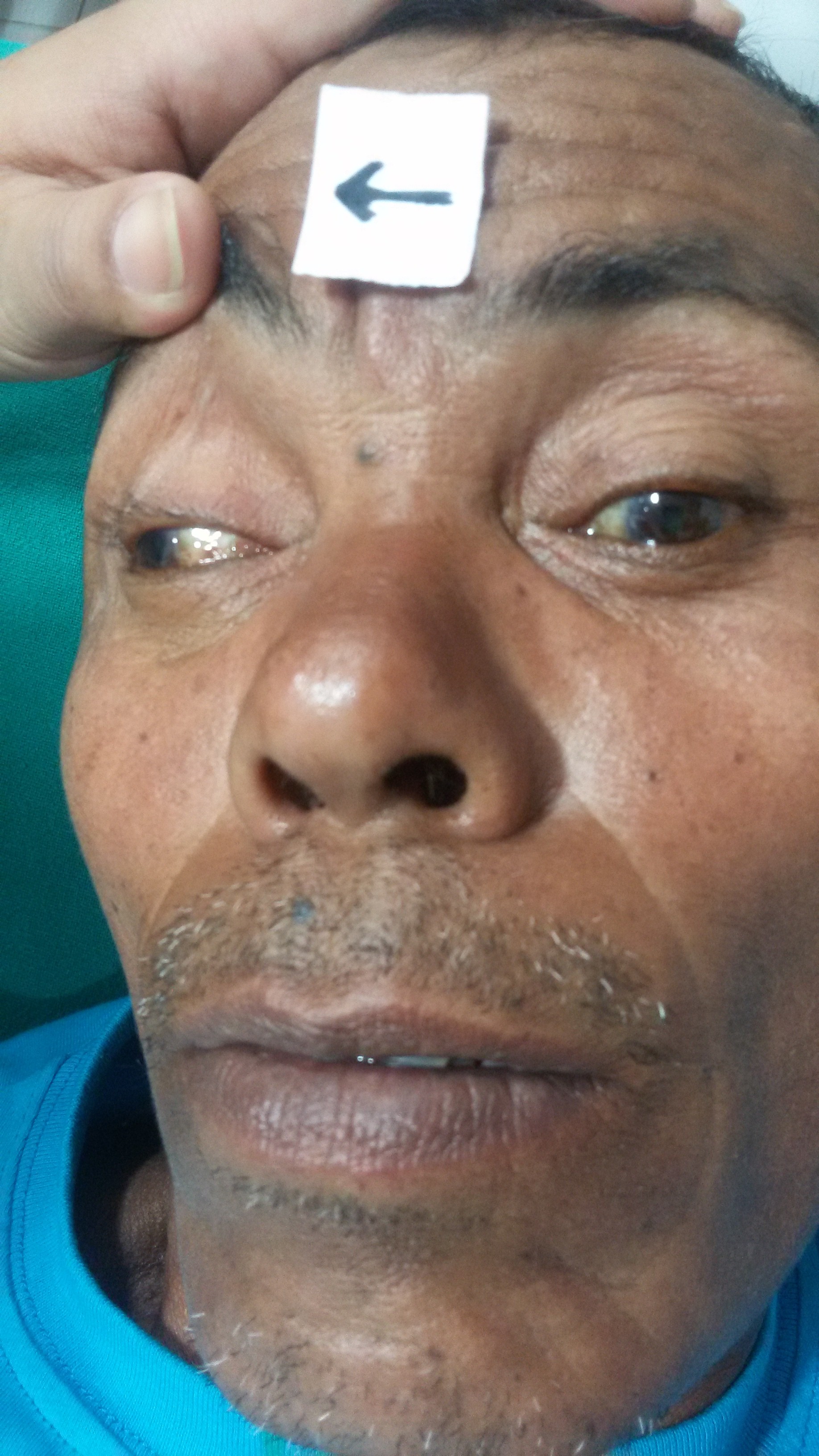 Oculomotor nerve palsy