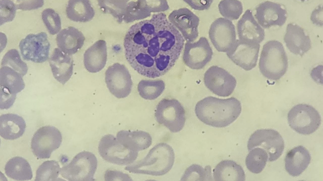 The peripheral smear shows characteristic hypersegmented neutrophil and macro ovalocytes which is found in megaloblastic anem