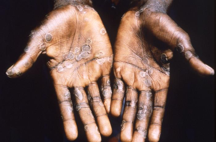 <p>Monkeypox Lesions on the Palms</p>