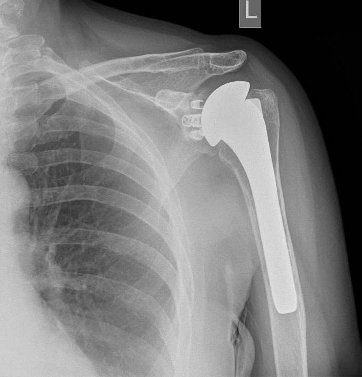 Figure 1; Left shoulder anteroposterior X-rays shows anatomical shoulder arthoplasty.