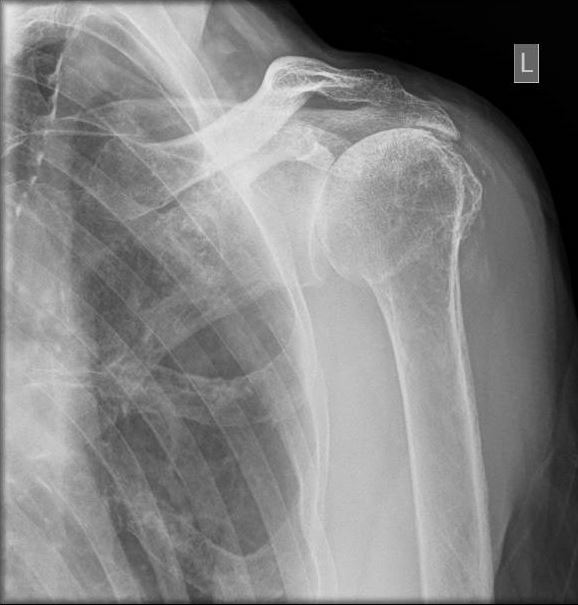 Figure 3; Left shoulder anteroposterior X-ray shows upward migration of the left humerual head and advanced glenohumeral arthritic changes