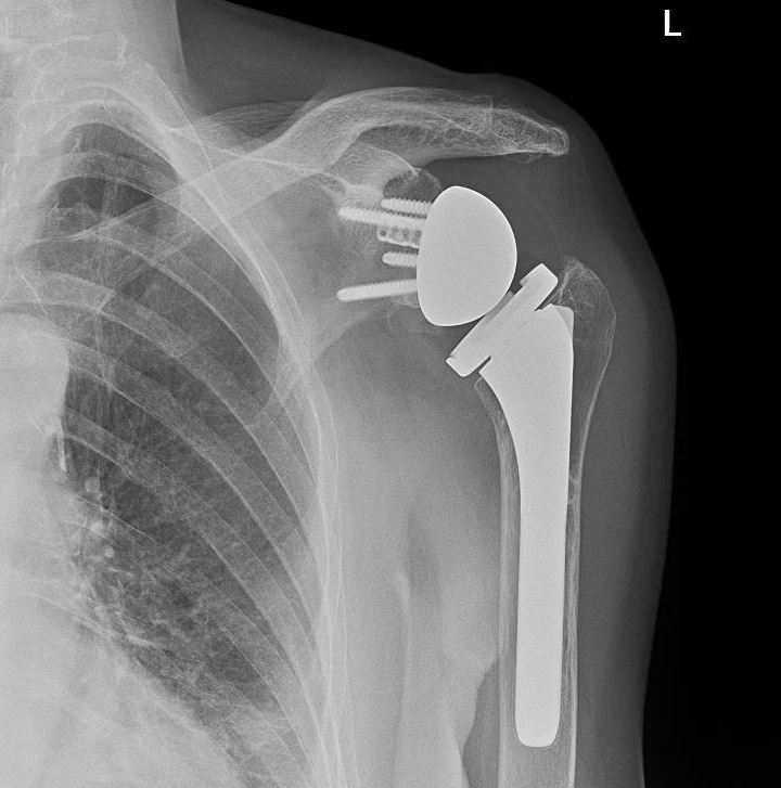 Description: Figure 2; Left shoulder anteroposterior X-ray shows a reverse total shoulder arthroplasty