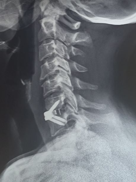 Zero profile implant for management of single level cervical disc prolapse