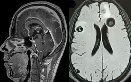 Disseminated neurocysticercosis