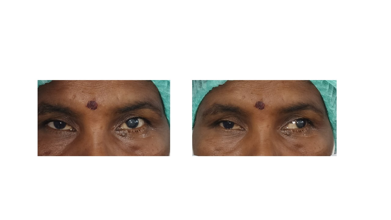 Clinical image of the patient depicting orthotropia for near and exotropia after the fusion is suspended following alternate 