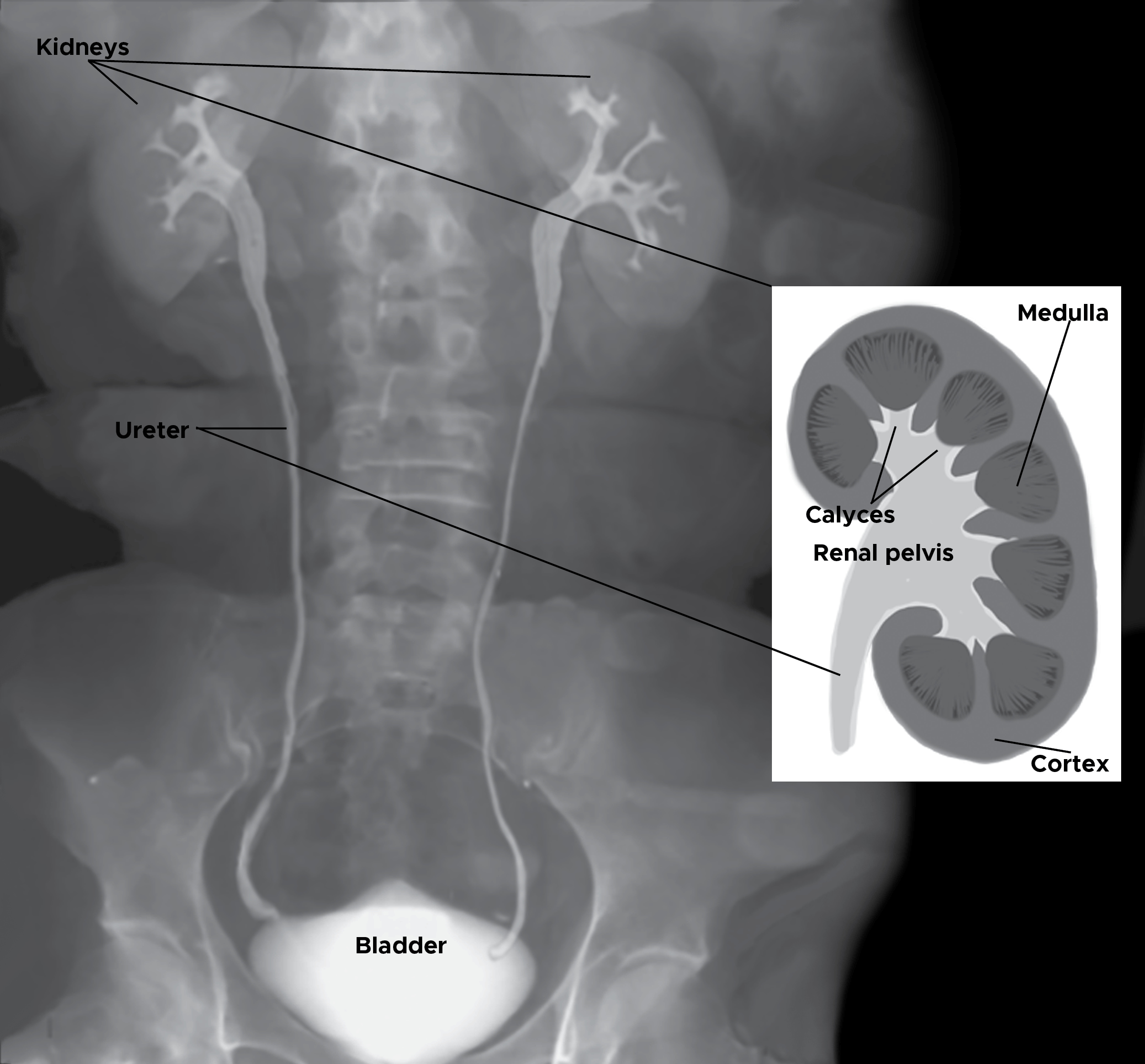 Labeled x-ray image and illustration of kidneys, ureter, bladder and abdomen.