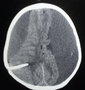 Bilateral chronic subdural hematoma due to shunt over-drain