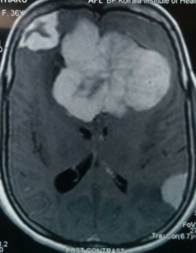 Multiple meningiomatosis