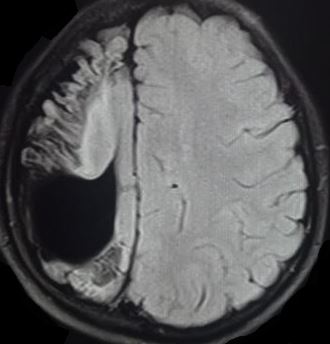 Seizure from the cortical changes and porencephalic cyst in a child secondary to a vascular insult sustained in a neonatal pe