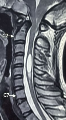 Arnold chiari with syrinx formation