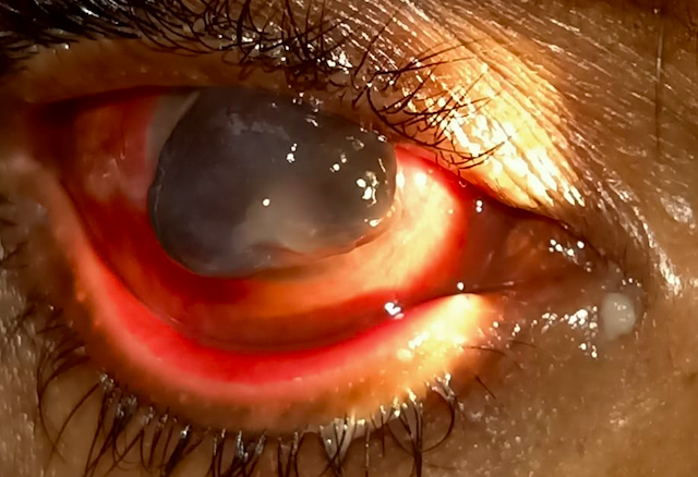 Slit lamp image depicting meibomian gland dysfunction, conjunctival congestion, total corneal melt, corneal perforation and a