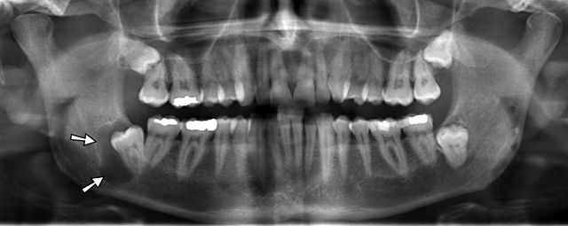 Radiograph showing odontogenic cyst in the right mandible.