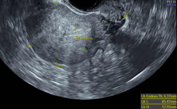 TVUS sagittal view of a uterus with anterior intramural mass with ill-defined borders vs thickened heterogenous myometrium, s