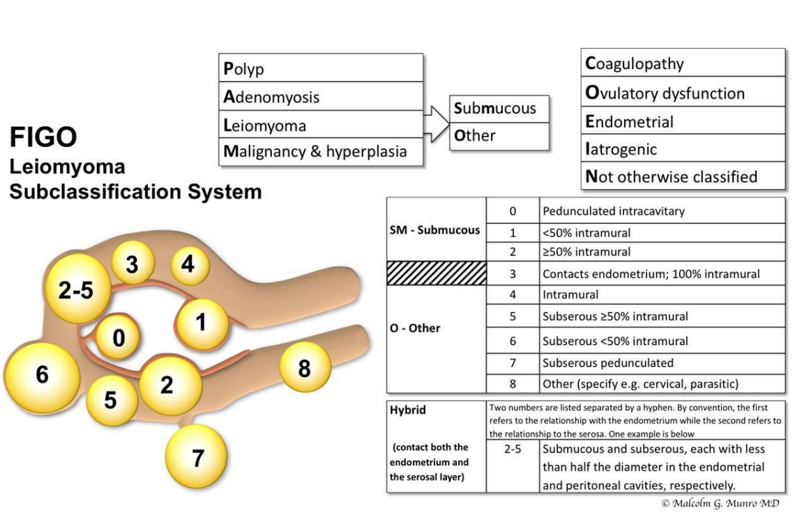 FIGO Leiomyoma Subclassification System, 2018 [30609040]