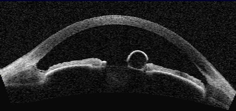 <p>AS-OCT of an Iris Cyst