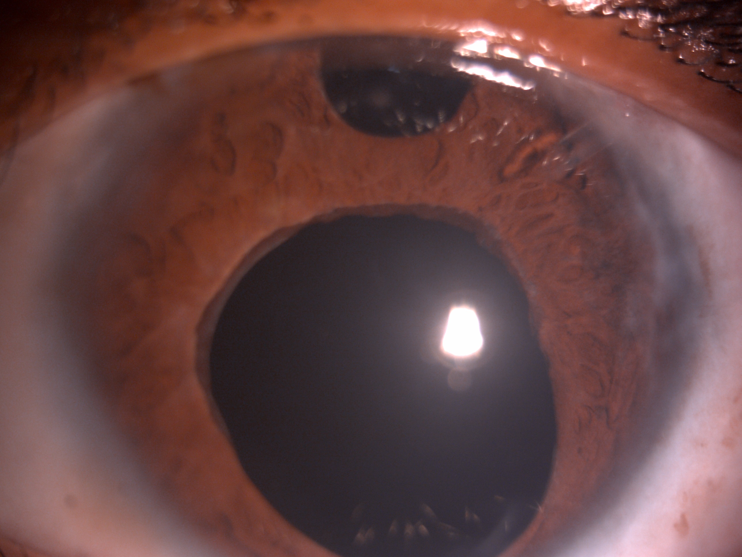 Slit lamp image of the child depicting megalocornea, tube shunt in the anterior chamber, surgical peripheral iridectomy, dila