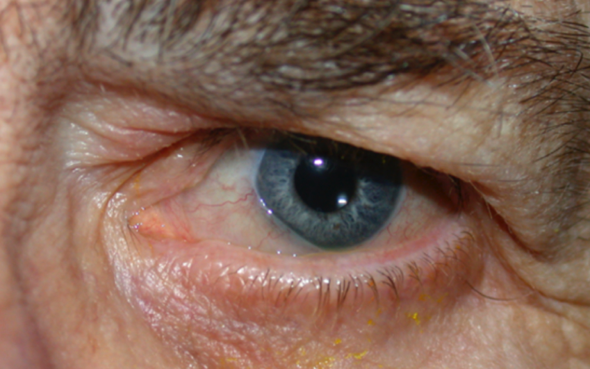 Photograph showing conjunctivochalasis in the left eye (male patient)