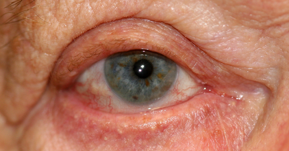 <p>Conjunctivochalasis, Grade 1. The image shows grade 1 conjunctivochalasis with mild ectropion.</p>