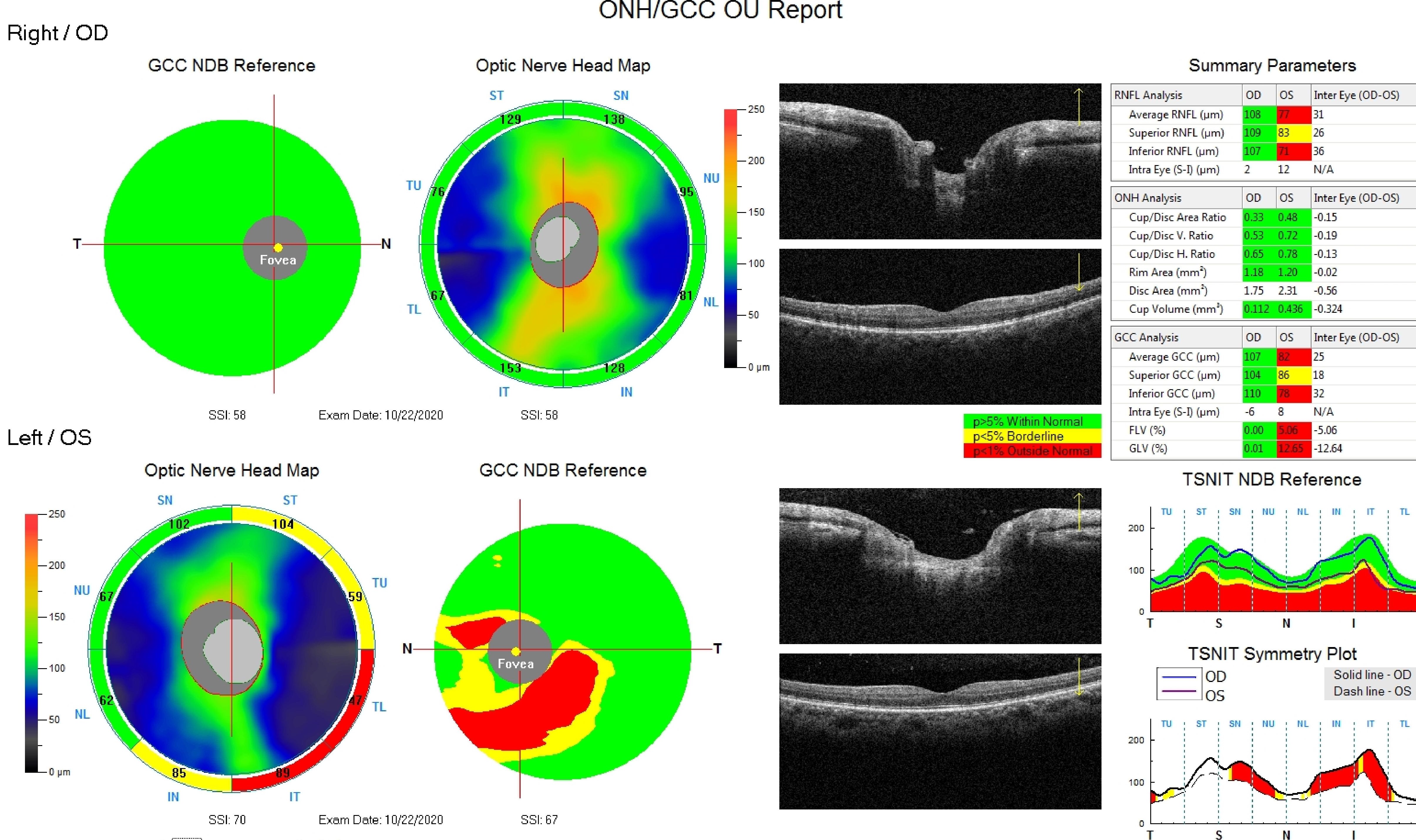 This image is an OCT evaluation of a male patient who suffers from Posner Schlossman syndrome in his left eye