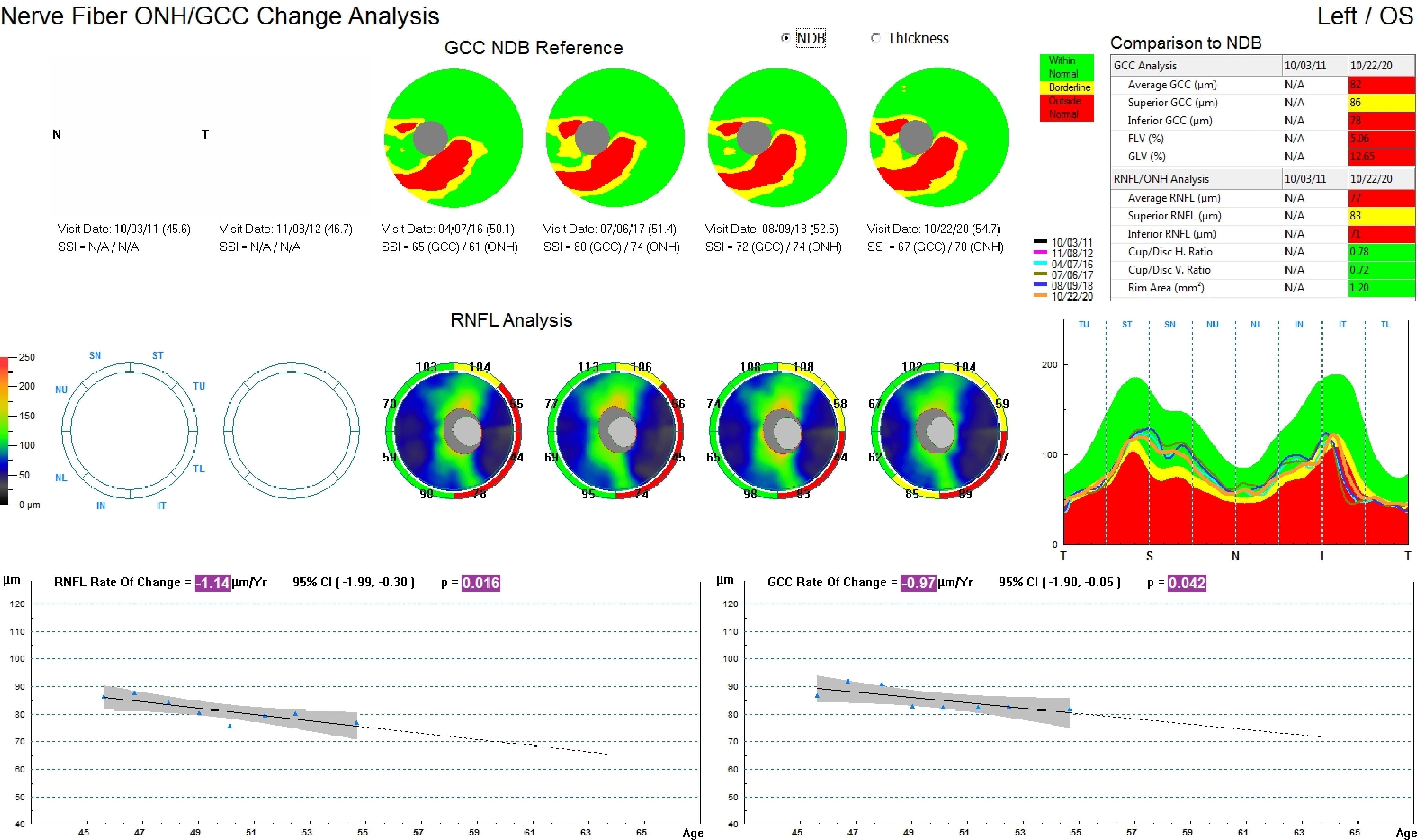 This image represents the change analysis over a nine year period of a male patient diagnosed with glaucomatocyclitic crisis in the left eye