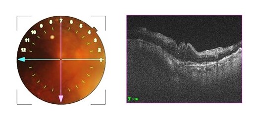 Figure 1: color fundus picture showing hazy vitreous media with multiple sub retinal yellow deposits and corresponding optica