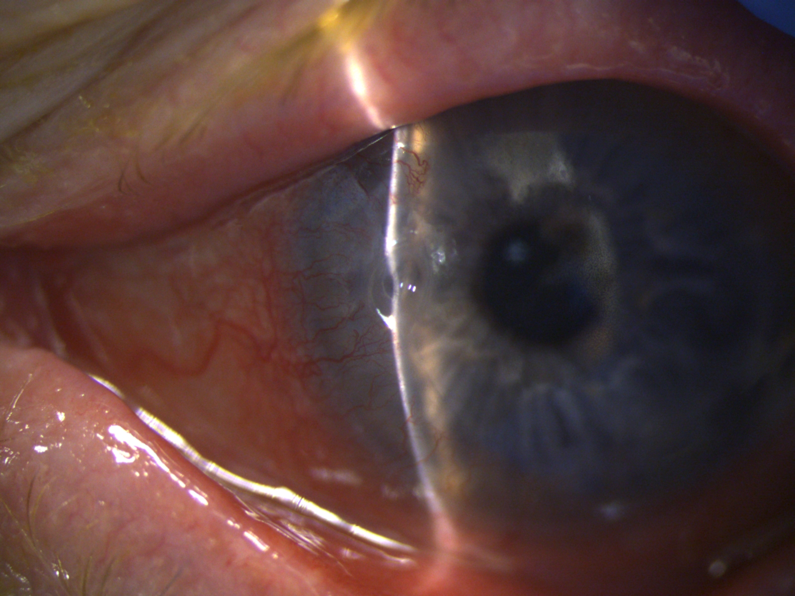 Figure 1. A patient with rheumatoid arthritis and peripheral ulcerative keratitis.