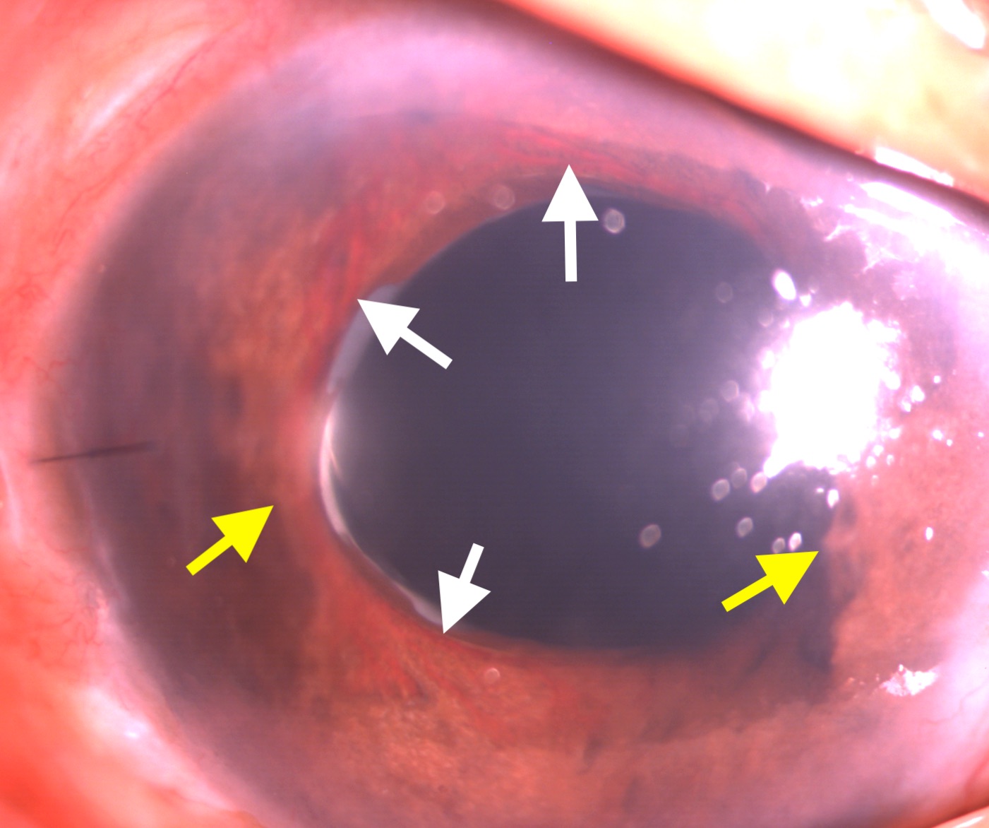 <p>Neovascularization of Iris and Peripheral Anterior Synechia