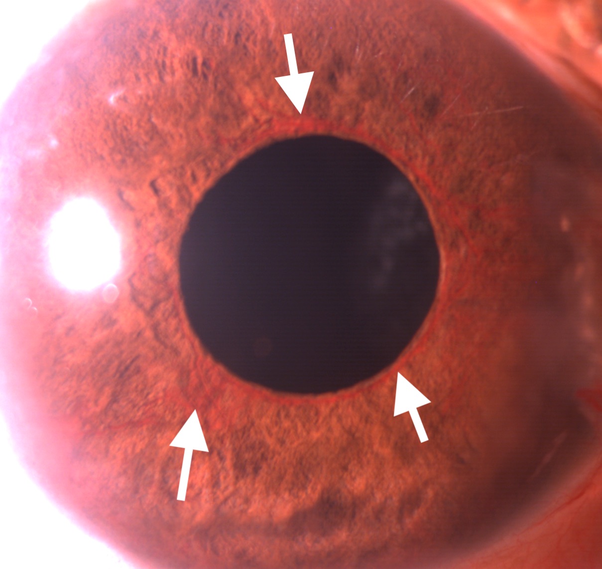 <p>Slit-lamp Examination Showing Neovascularization of Iris