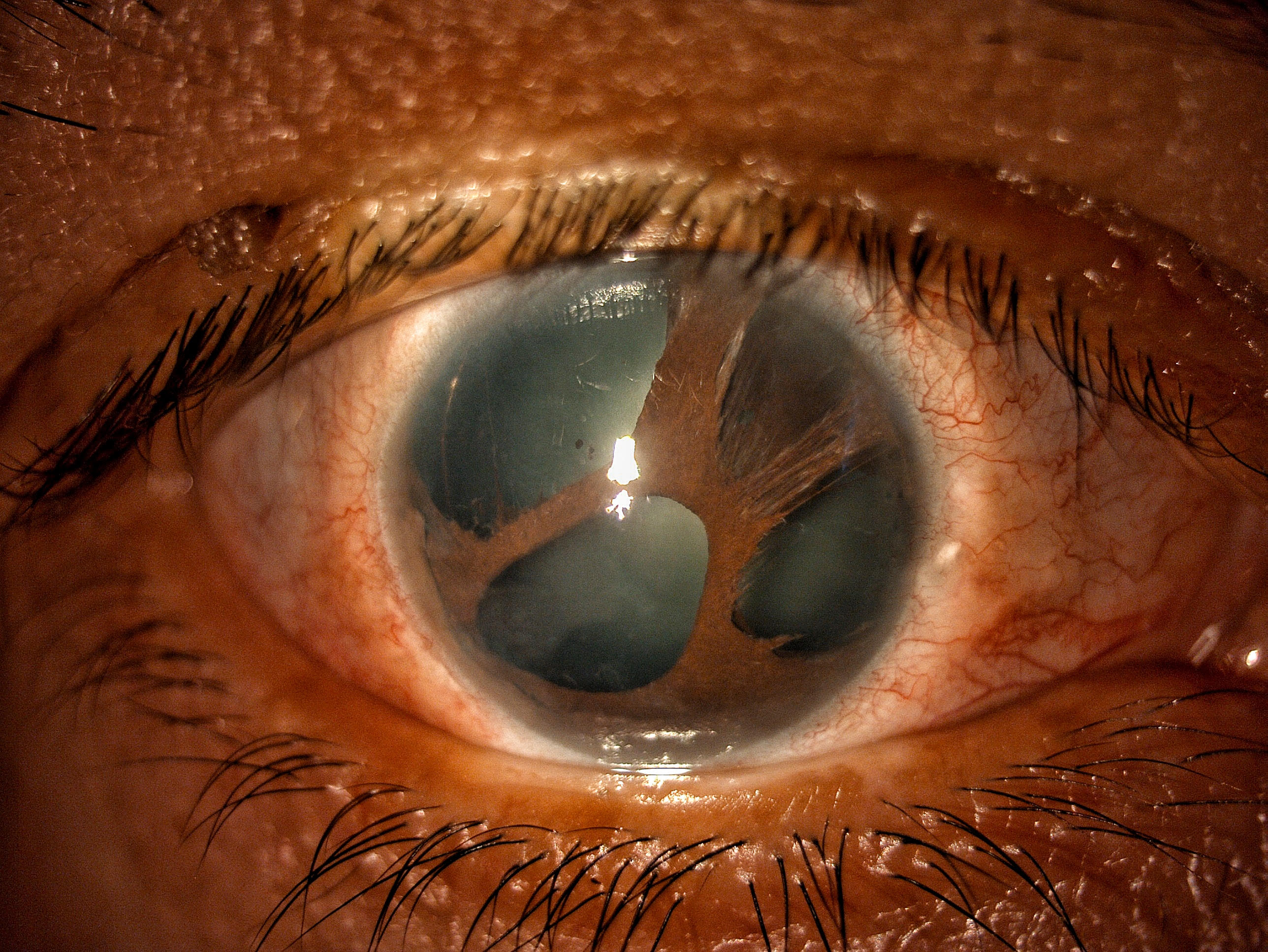 Iridocorneal Endothelial Syndrome: Essential Endothelial Syndrome