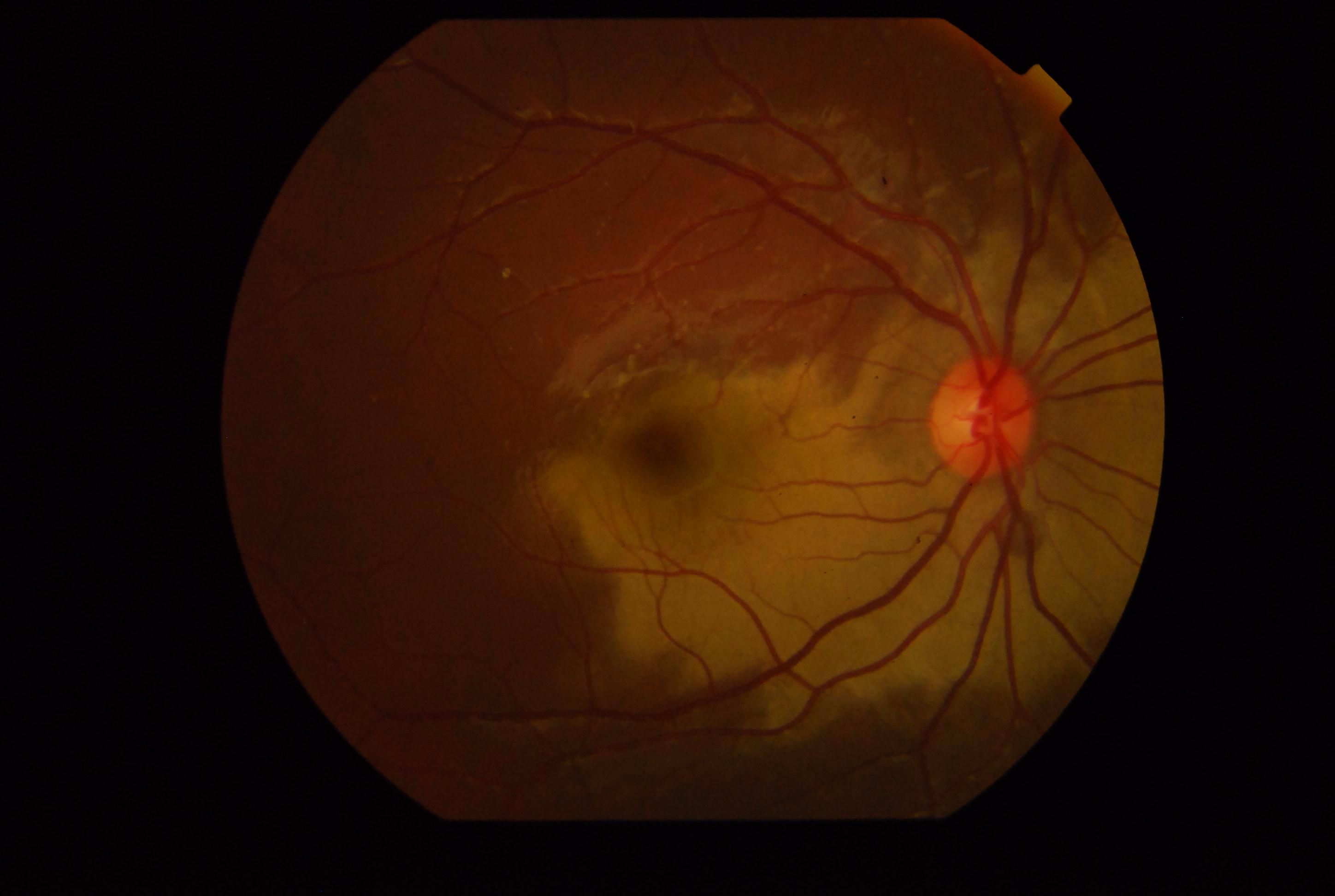 <p>Commotio Retinae With Foveal Involvement