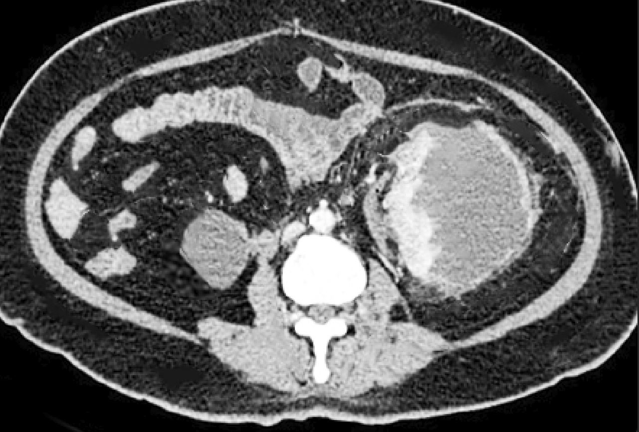 <p>Page Kidney. This image of a CT scan reveals Page kidney.</p>