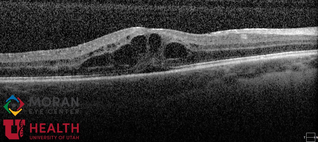 <p>Cystoid Macular Edema due to Uveitis