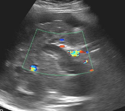 Thrombosis of the portal vein