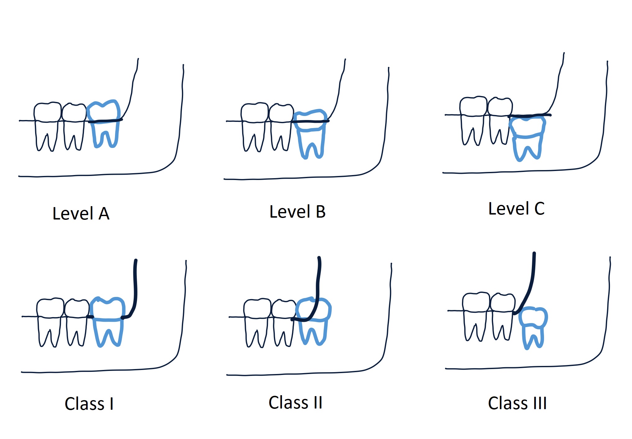 Pell and Gregory's Classification