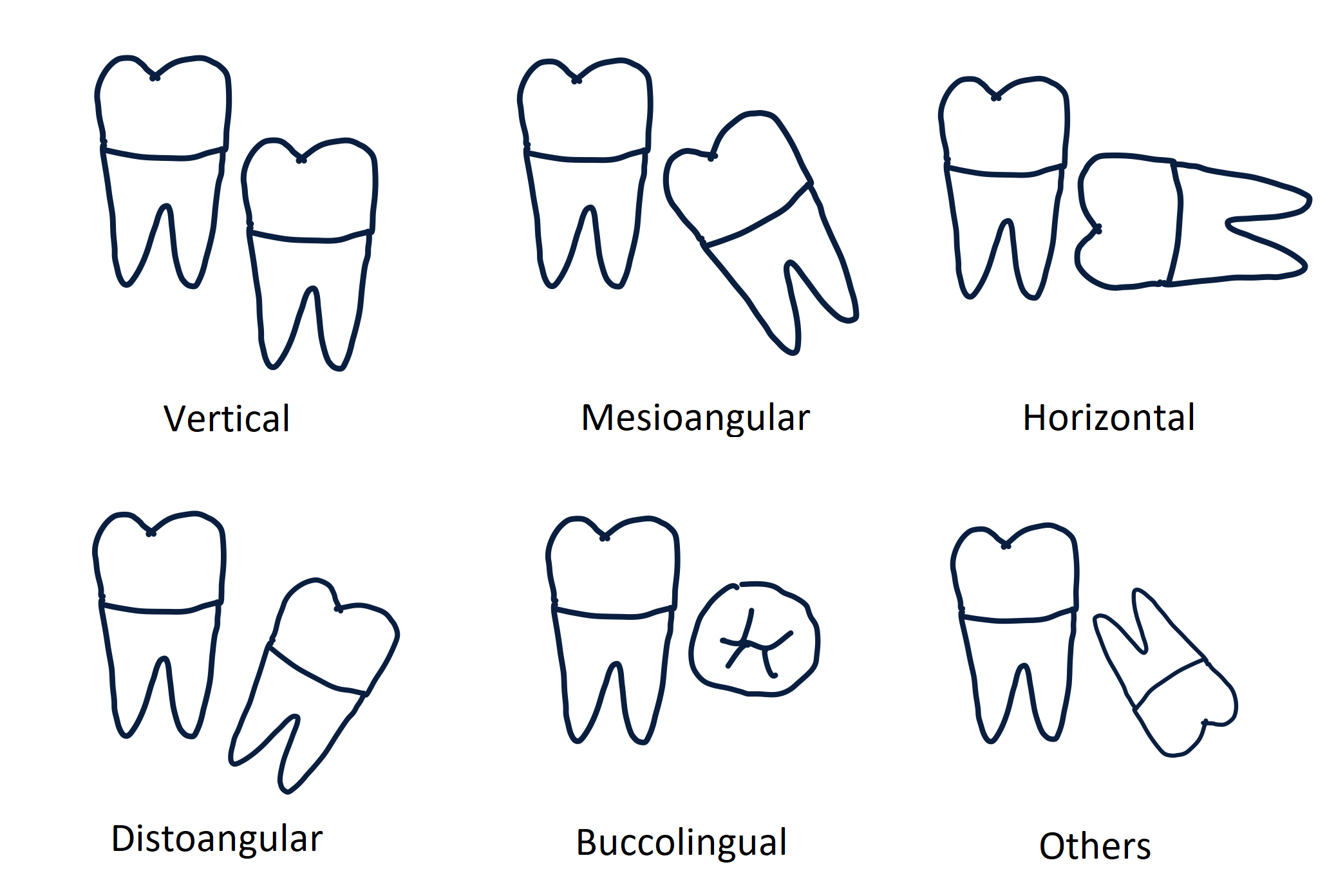 Winter's Classification of Third molar Angulation