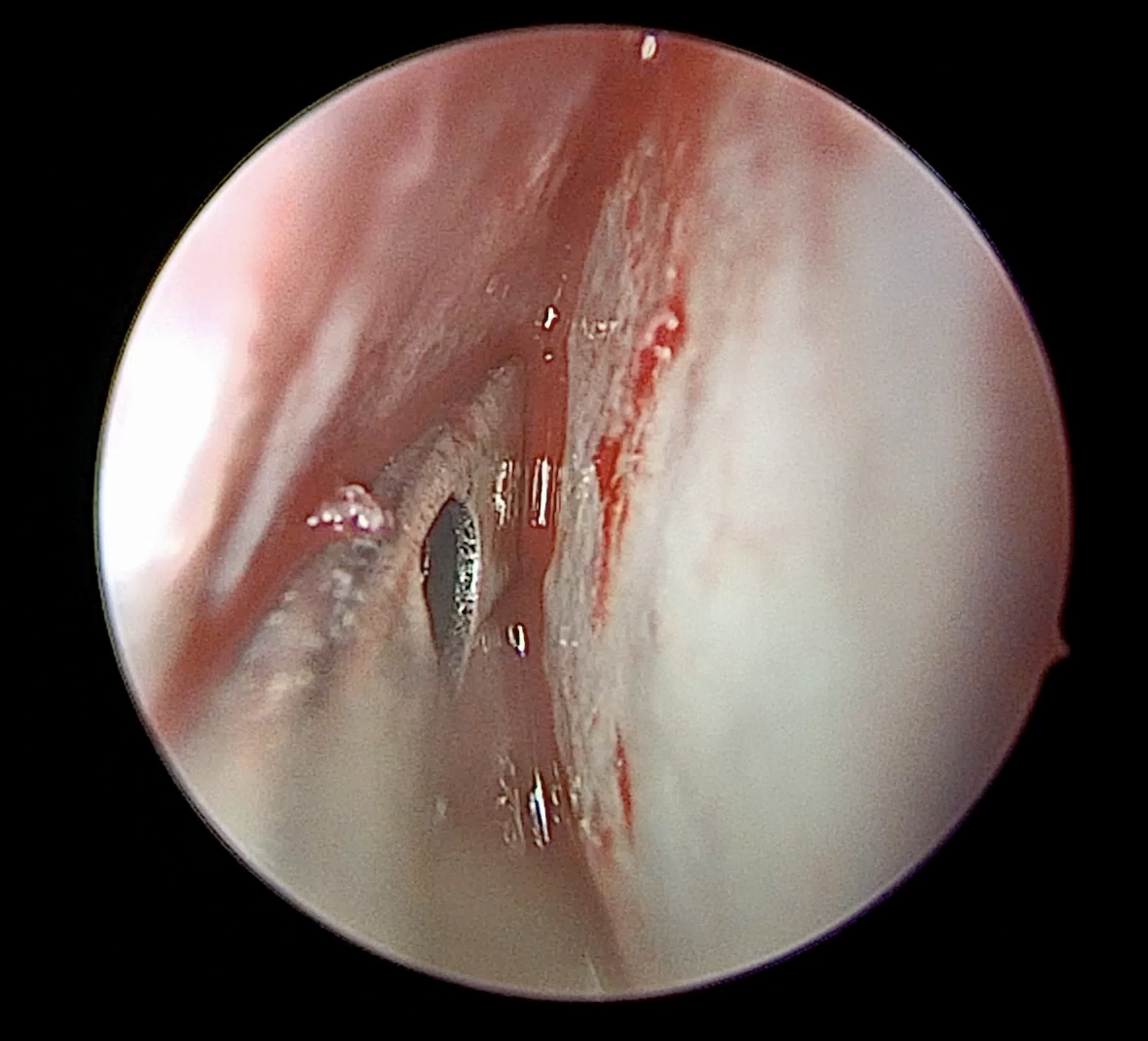 Elevation of nasoseptal flap using suction Freer elevator.