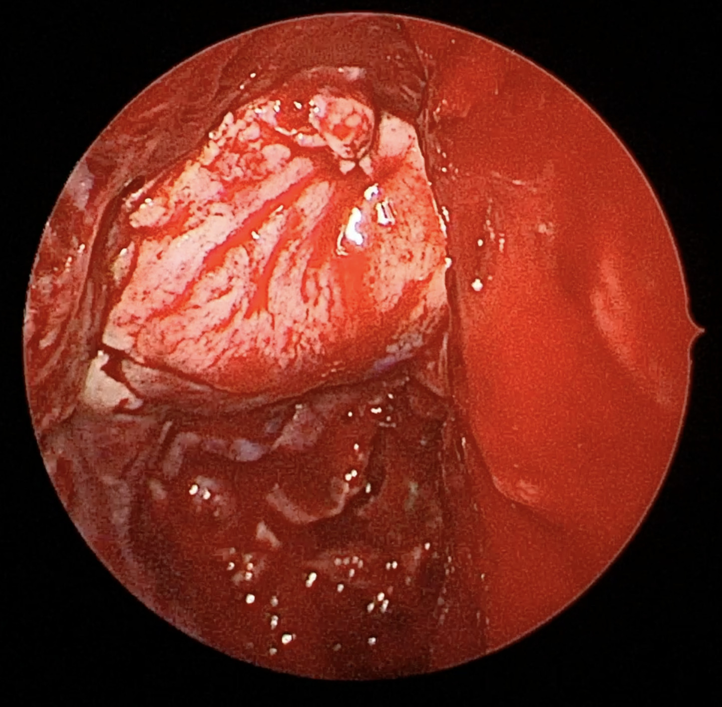 Anterior skull base reconstruction with nasoseptal flap