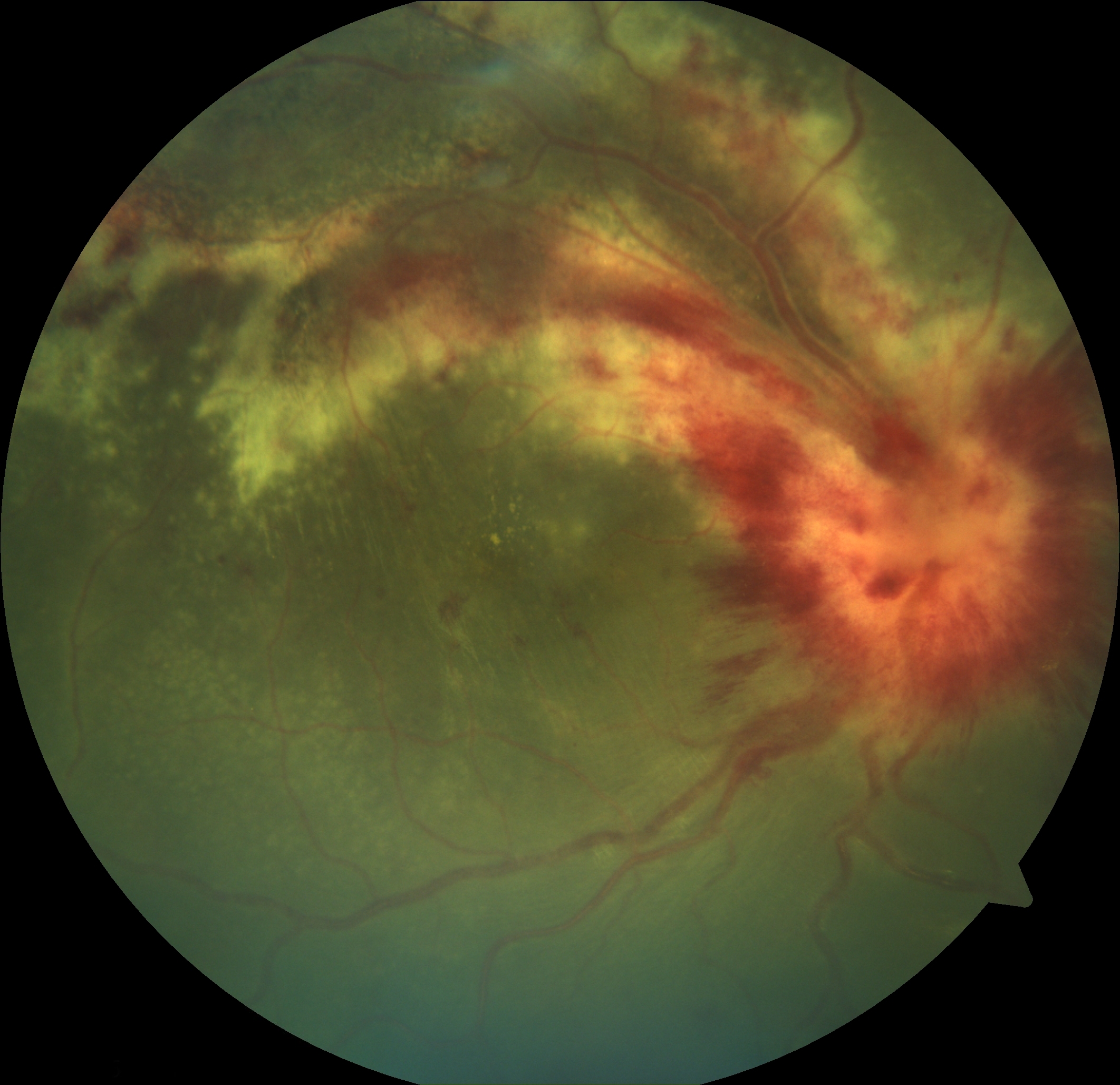 <p>Cytomegalovirus and Associated Hemorrhages