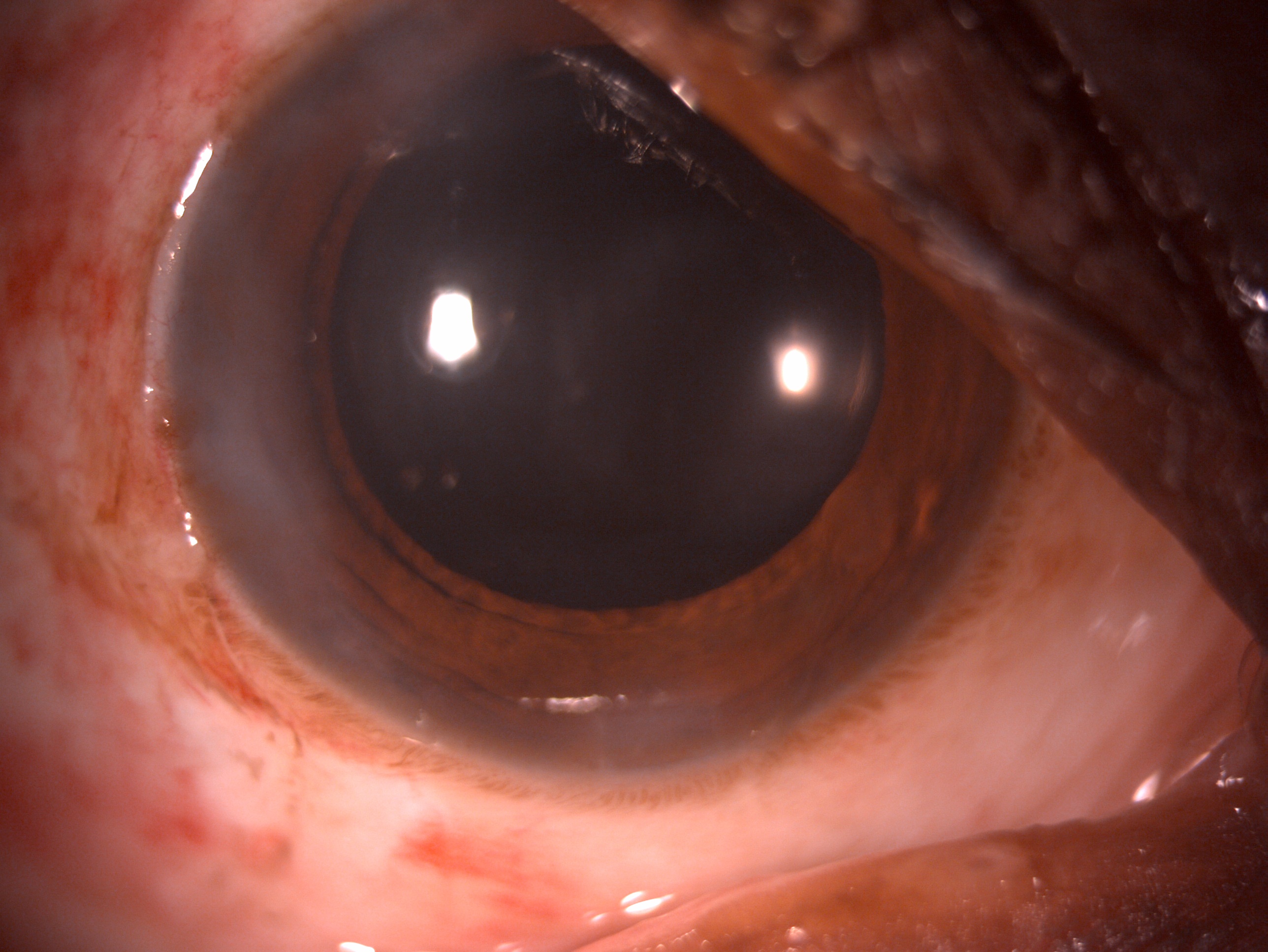 Postoperative day 1 slit lamp image of the patient after undergoing phacoemulsification with stable intraocular lens