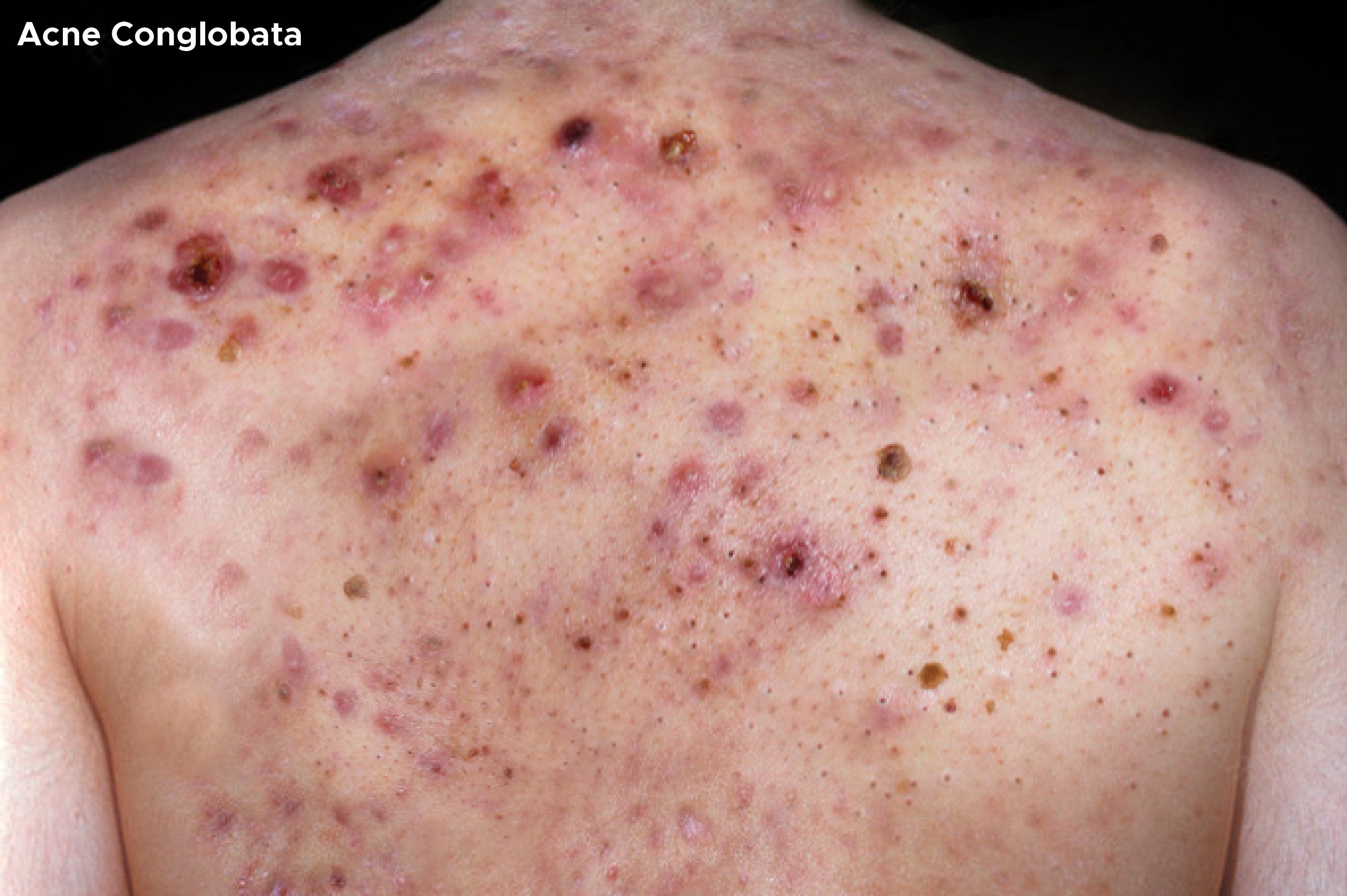 Acne Conglobata on back and shoulders.