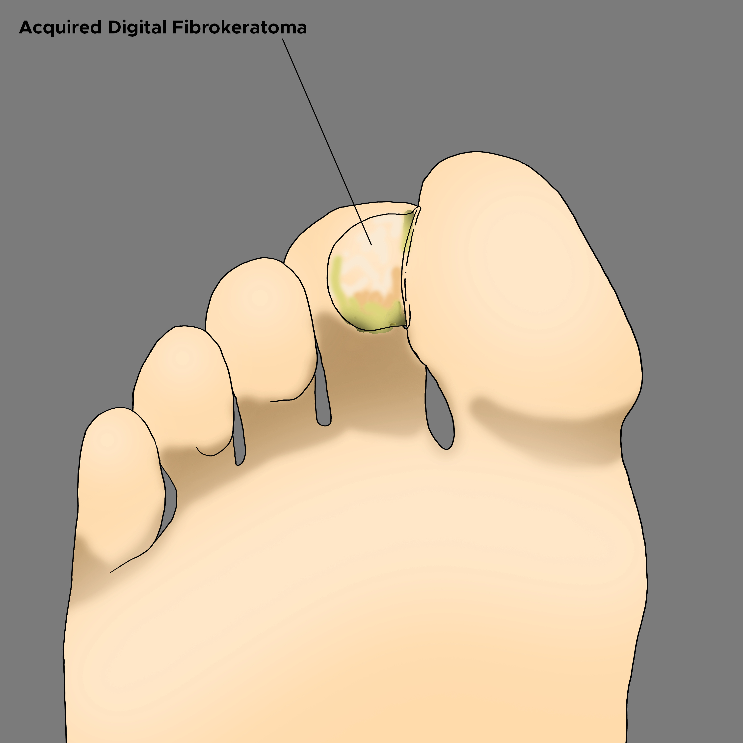 Illustration of Acquired Digital Fibrokeratoma on toe.