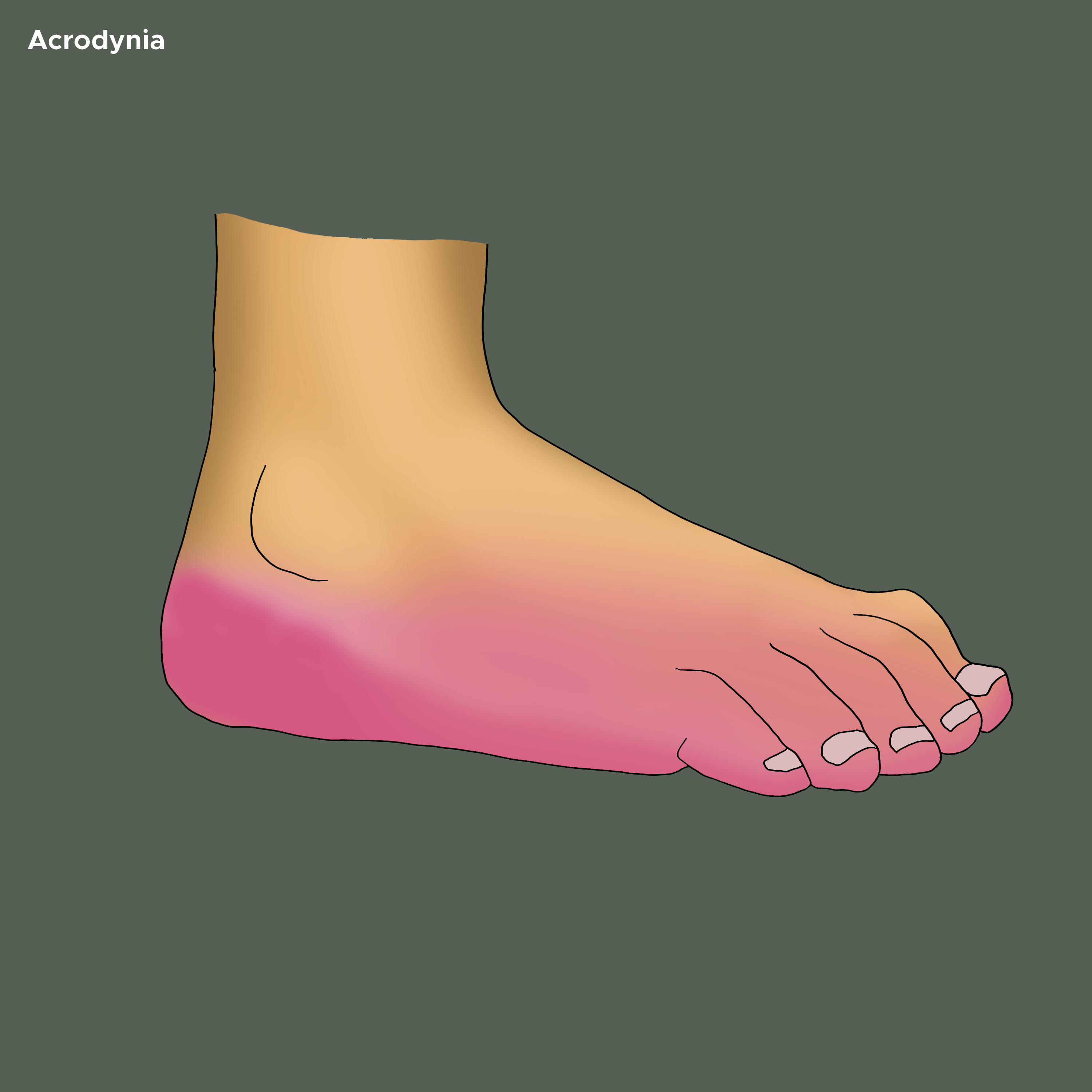 <p>Acrodynia on the Bottom of Foot</p>