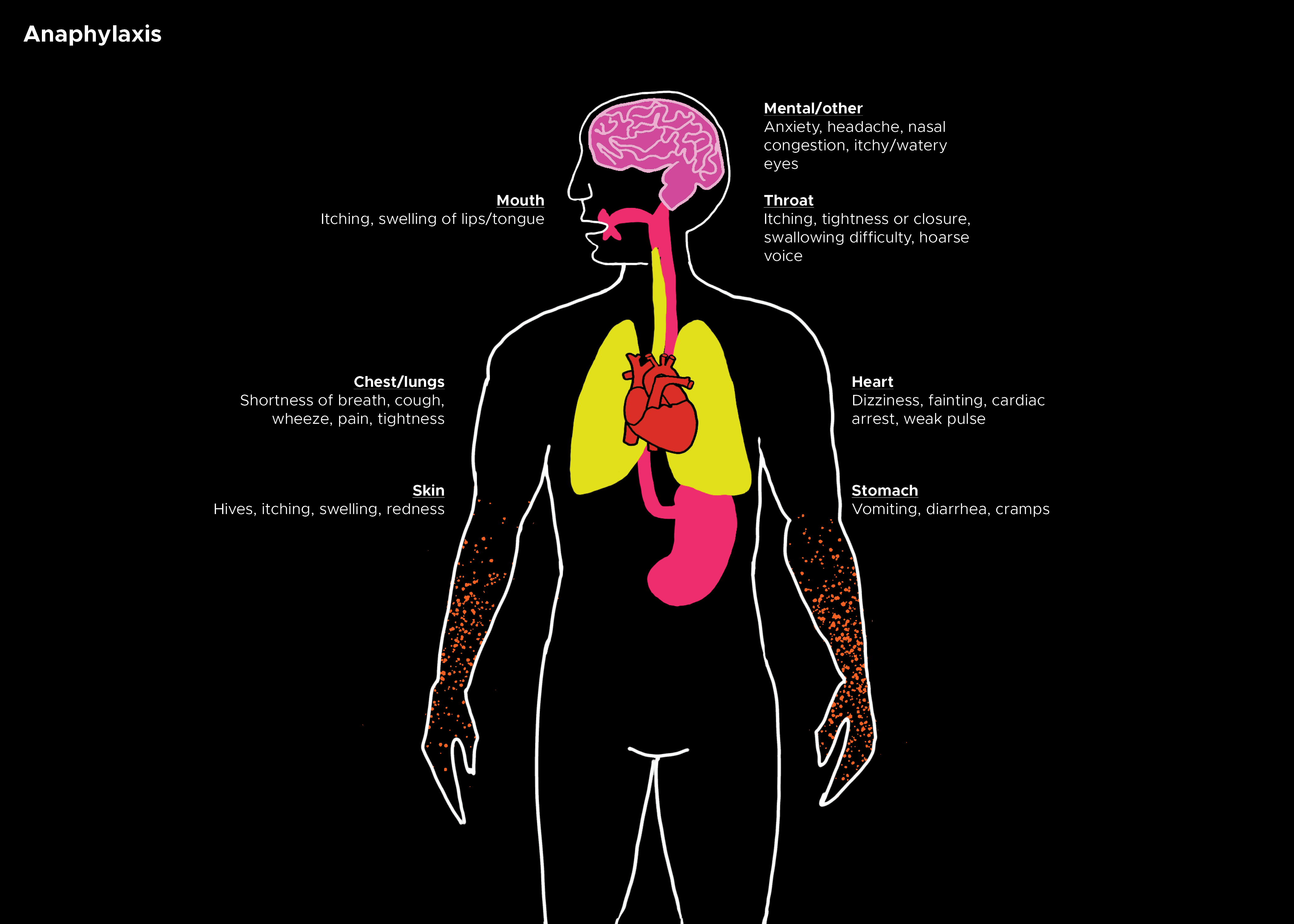 <p>Anaphylaxis