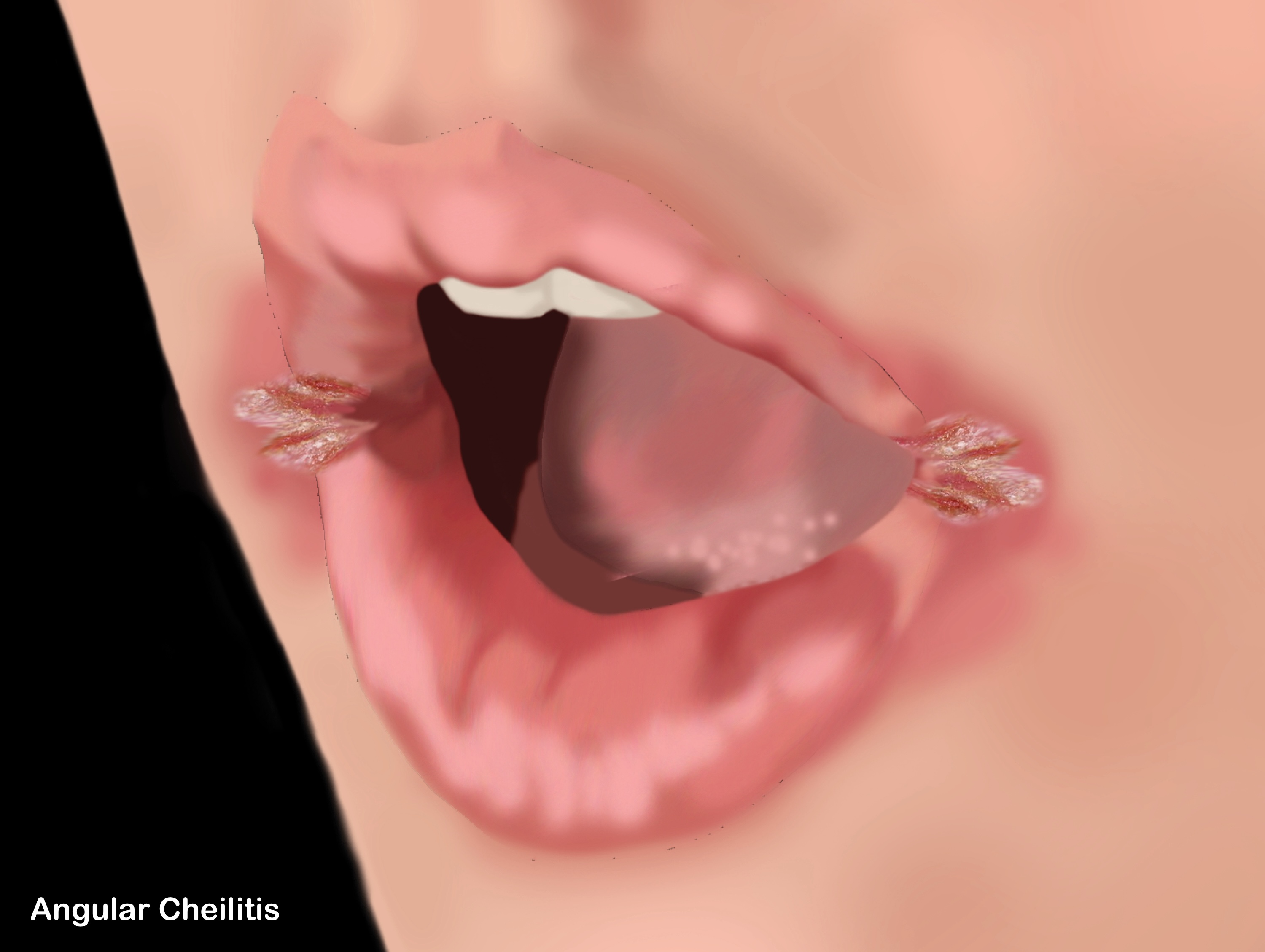 <p>Angular Cheilitis. Illustration of cracks in corners of mouth due to angular cheilitis.</p>