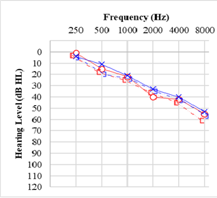 <p>Audiogram for Presbycusis.</p>