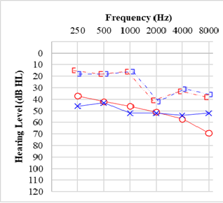 <p>Audiogram for Otosclerosis</p>