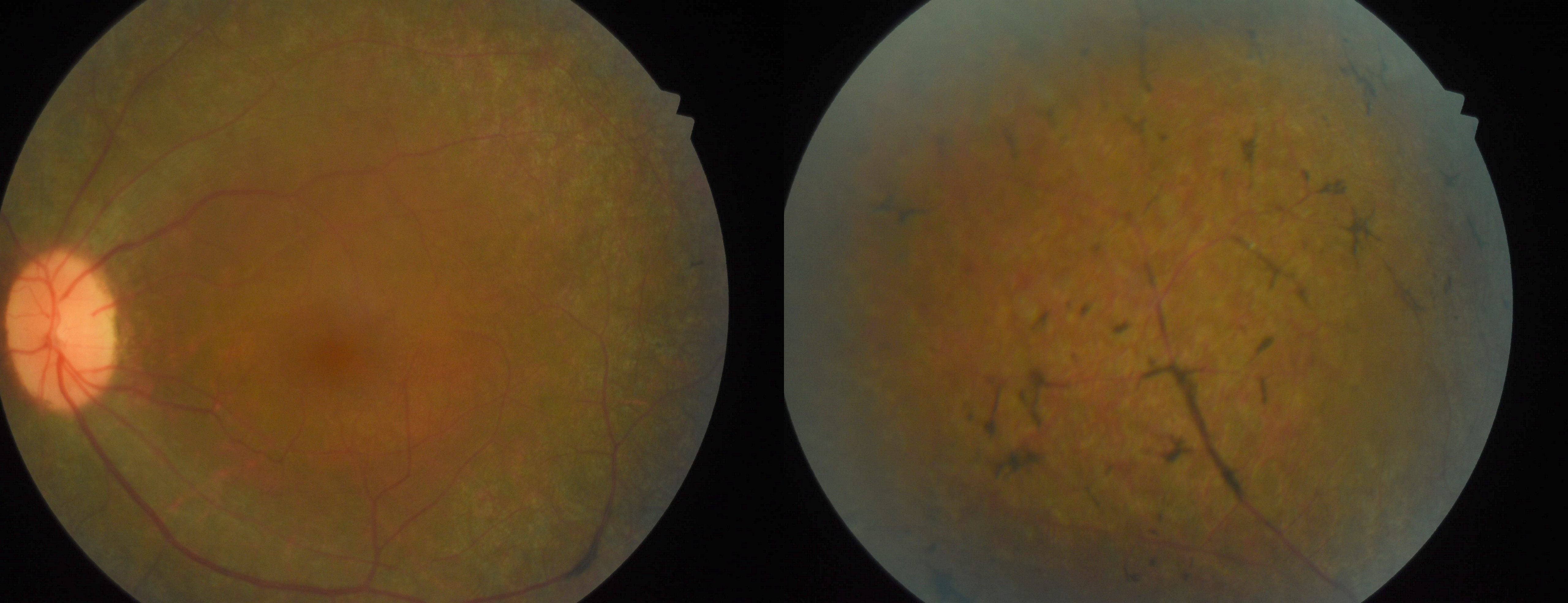 <p>Fundus Showing Bony Spicules</p>